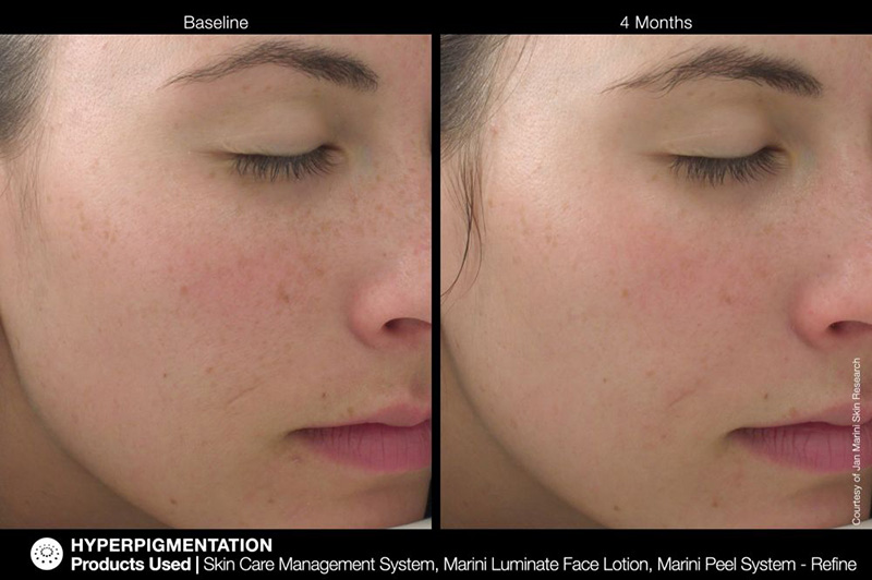 Marini SkinSolutions Luminate® Face Lotion Lotion depigmentacyjny 30 ml